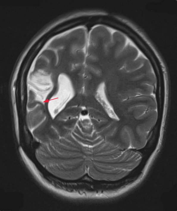 3A1 Epilepsy, MCA infarct, ulegyria (Case 3)  T2-TSE-COR 512-3mm no C 2 - Copy