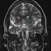 3A2 Epilepsy, MCA infarct, ulegyria (Case 3)  T2-TSE-COR 512-3mm no C 3 - Copy