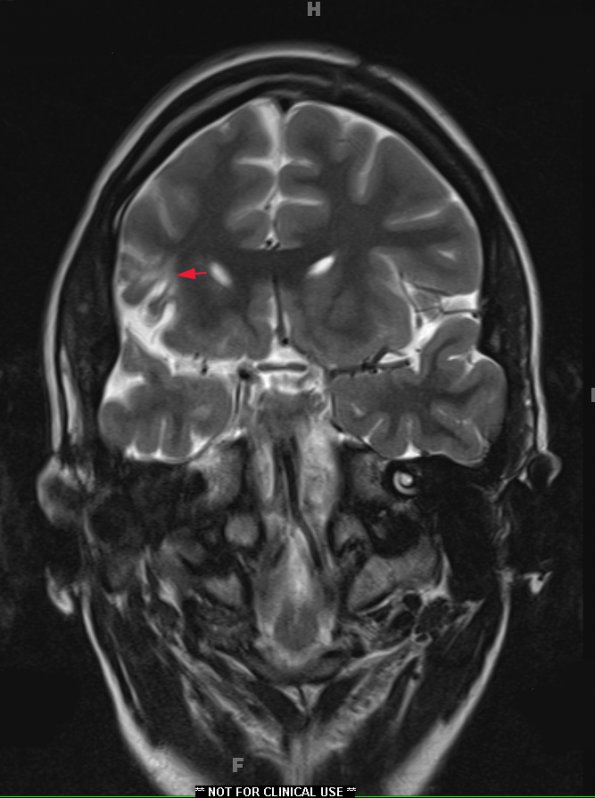 3A2 Epilepsy, MCA infarct, ulegyria (Case 3)  T2-TSE-COR 512-3mm no C 3 - Copy