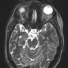 3A3 Epilepsy, MCA infarct, ulegyria (Case 3)T2 TSE AX STEALTH no C - Copy