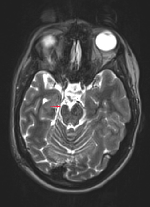 3A3 Epilepsy, MCA infarct, ulegyria (Case 3)T2 TSE AX STEALTH no C - Copy