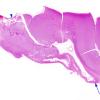 3B1 Epilepsy, neonatal MCA infarct (Case 3) H&E whole mount 2