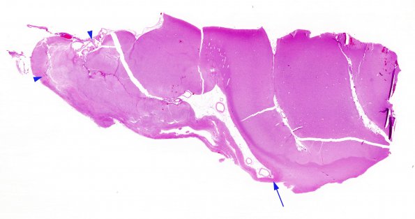 3B1 Epilepsy, neonatal MCA infarct (Case 3) H&E whole mount 2