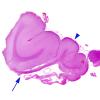 3B2 Epilepsy, neonatal MCA infarct ulegyria (Case 3) H&E  whole mount 3