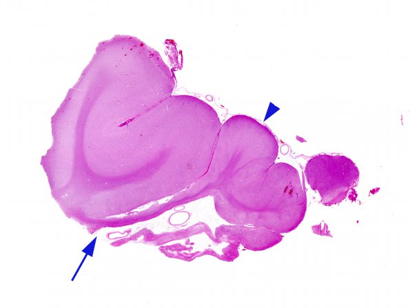 3B2 Epilepsy, neonatal MCA infarct ulegyria (Case 3) H&E  whole mount 3