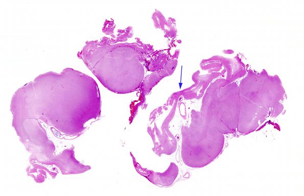 3B3 Epilepsy, neonatal MCA infarct (Case 3) H&E whole mount