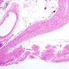 3B4 Epilepsy, neonatal MCA infarct, ulegyria (Case 3) H&E 4