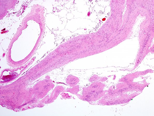 3B4 Epilepsy, neonatal MCA infarct, ulegyria (Case 3) H&E 4