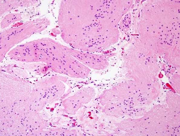 3B5 Epilepsy, neonatal MCA infarct, ulegyria (Case 3) H&E 2