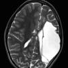 4A1 Infarct, MCA (Case 4) T2 TSE AX STEALTH - Copy