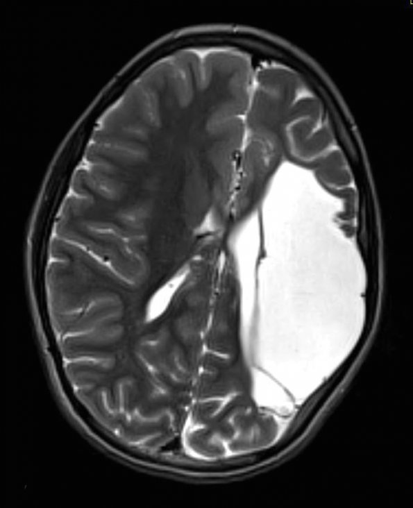 4A1 Infarct, MCA (Case 4) T2 TSE AX STEALTH - Copy