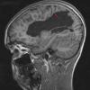 4A2 Infarct, MCA (Case 4) MPRAGE T1 Sagittal IPAT - Copy