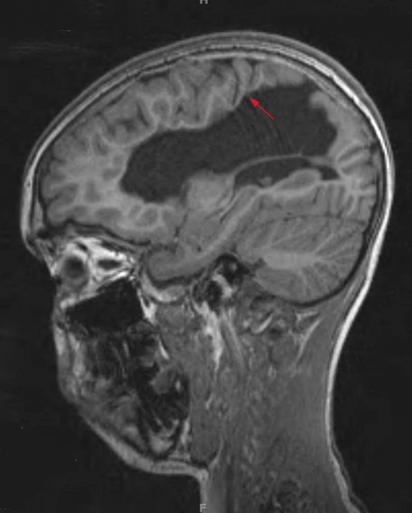 4A2 Infarct, MCA (Case 4) MPRAGE T1 Sagittal IPAT - Copy