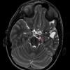 4A3 Infarct, MCA (Case 4) T2 TSE AX STEALTH 2 - Copy