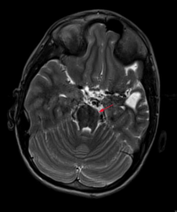 4A3 Infarct, MCA (Case 4) T2 TSE AX STEALTH 2 - Copy