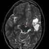 4A4 Infarct, MCA (Case 4) T2 TSE AX STEALTH 3 - Copy