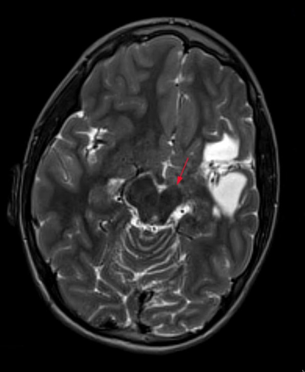 4A4 Infarct, MCA (Case 4) T2 TSE AX STEALTH 3 - Copy