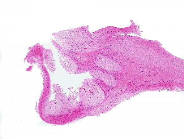 4B1 Infarct, MCA (Case 4) H&E 1