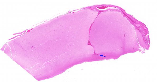 4B2 Ulegyria, Infarct, MCA (Case 4) H&E whole mount