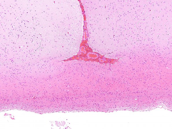 4B3 Ulegyria, Infarct, MCA (Case 4) H&E 1A