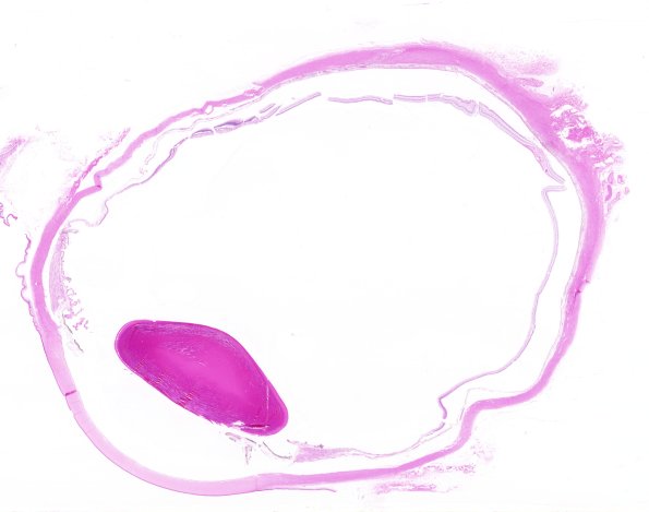 Eye, Von Hippel Lindau, normal side (Case 1) 1 H&E whole mount