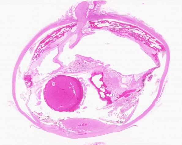 Eye, Von Hippel Lindau, tumor side (Case 1) 2 H&E whole mount