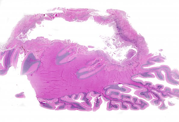 Abscess (Case 1)