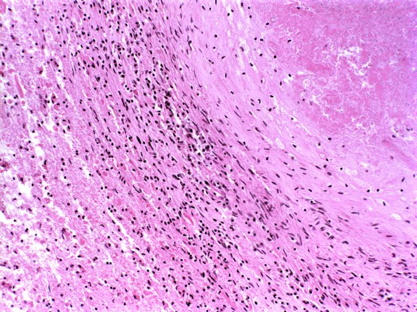 Abscess (Case 4) H&E 1