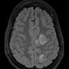 1A1 Abscess-Cerebritis (Case 1) FLAIR 1 - Copy (2)