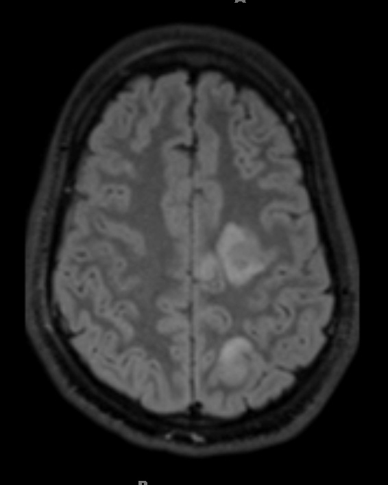 1A1 Abscess-Cerebritis (Case 1) FLAIR 1 - Copy (2)