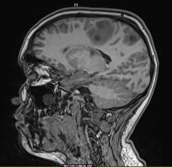 1A2 Abscess-Cerebritis (Case 1) T1 MPRAGE 1 - Copy (2)