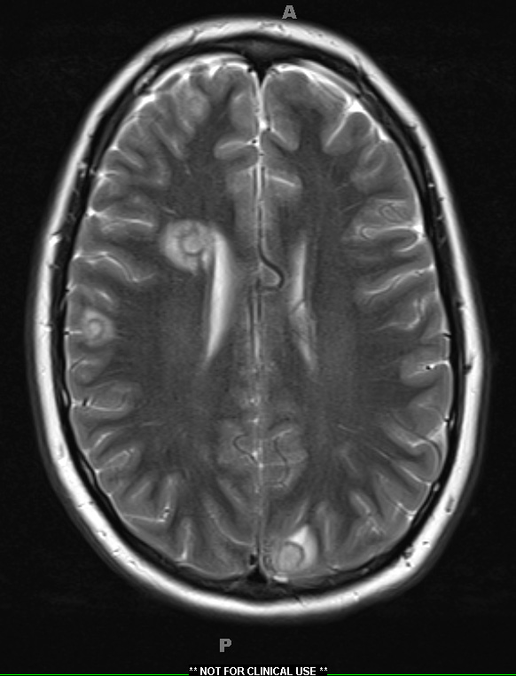 1A4 Abscess-Cerebritis (Case 1) T2 W 2 - Copy