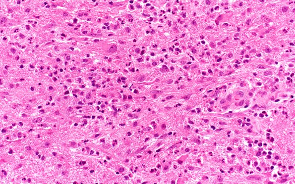 1B2 Abscess-Cerebritis (Case 1) H&E 3 (2)