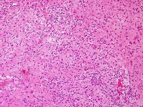 1B3 Abscess-Cerebritis (Case 1) H&E 5