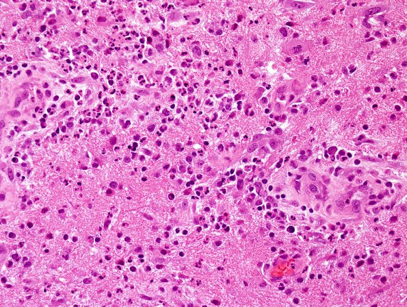 1B4 Abscess-Cerebritis (Case 1) H&E 9