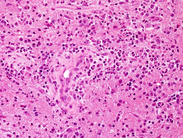 1B5 Abscess-Cerebritis (Case 1) H&E 3