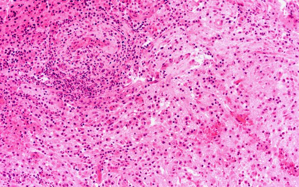 1B6 Abscess-Cerebritis (Case 1) H&E 2 (2)