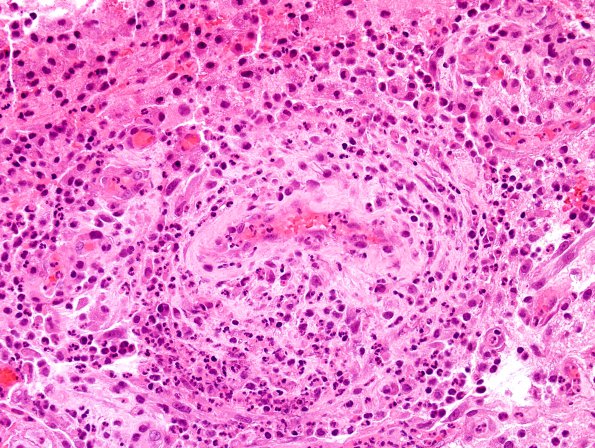 1B7 Abscess-Cerebritis (Case 1) H&E 4