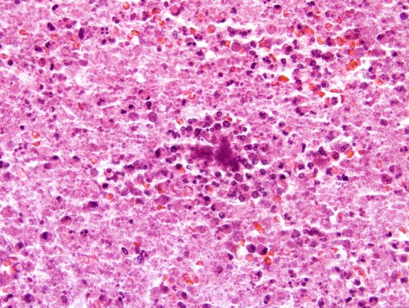 1B8 Abscess-Cerebritis (Case 1) H&E 1