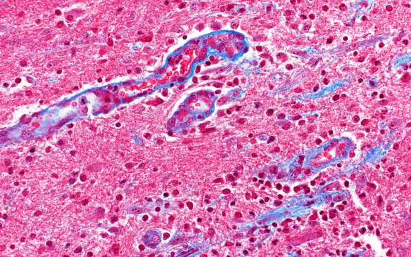 1B9 Abscess-Cerebritis (Case 1) Trichrome 1