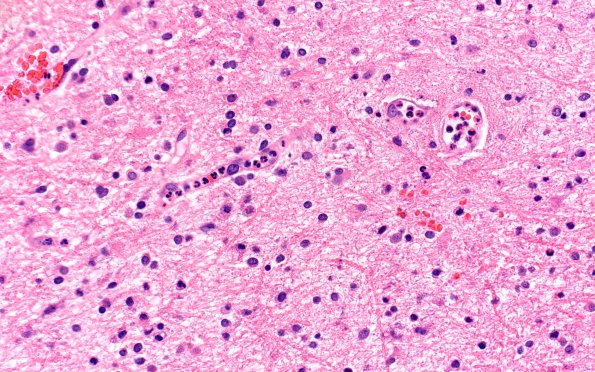 2A1 Cerebritis-Early Abscess (S anginosus, Case 2) H&E 12