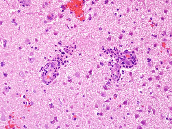 2A2 Cerebritis-Early Abscess (S anginosus, Case 2) H&E 5