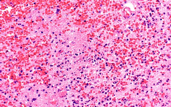 2A3 Cerebritis-Early Abscess (S anginosus, Case 2) H&E 9