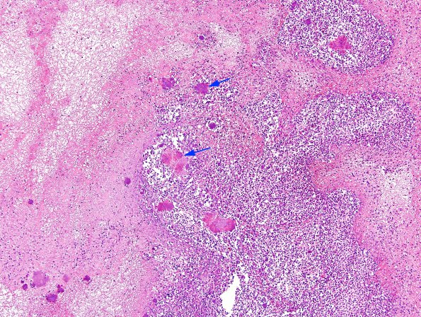 2A5 Cerebritis-Early Abscess (S anginosus, Case 2) H&E 7 copy