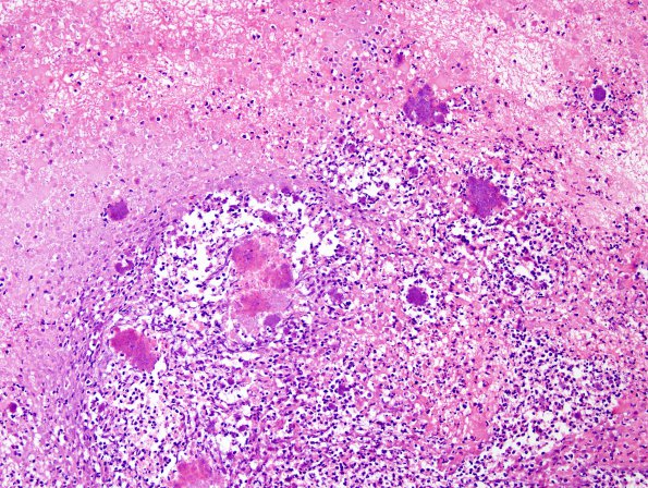 2A6 Cerebritis-Early Abscess (S anginosus, Case 2) H&E 10