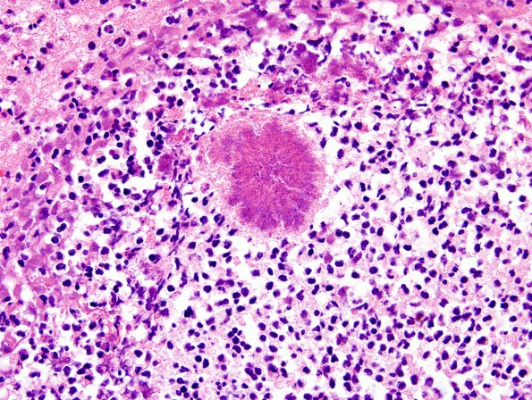 2A8 Cerebritis-Early Abscess (S anginosus, Case 2) H&E 9