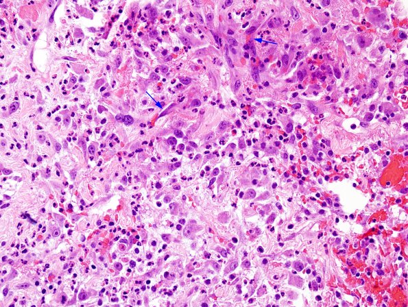 2B3 Cerebritis-Early Abscess (S anginosus, Case 2) H&E 4 copy