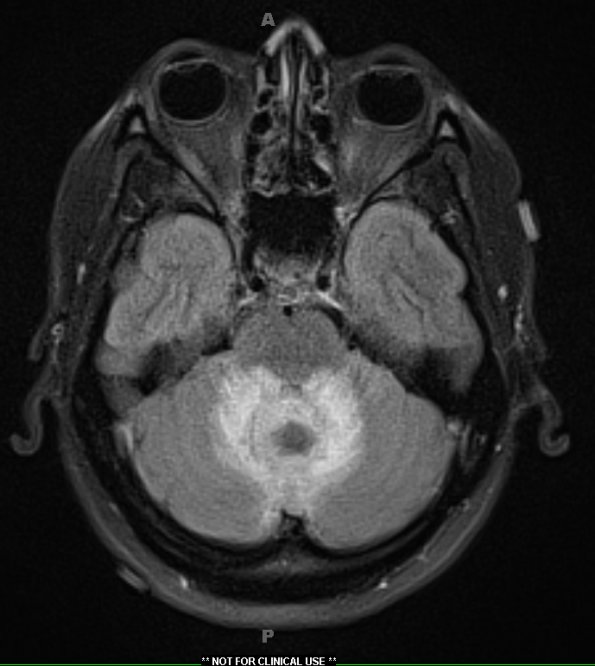 3A1 Cerebritis (Case 3) FLAIR - Copy