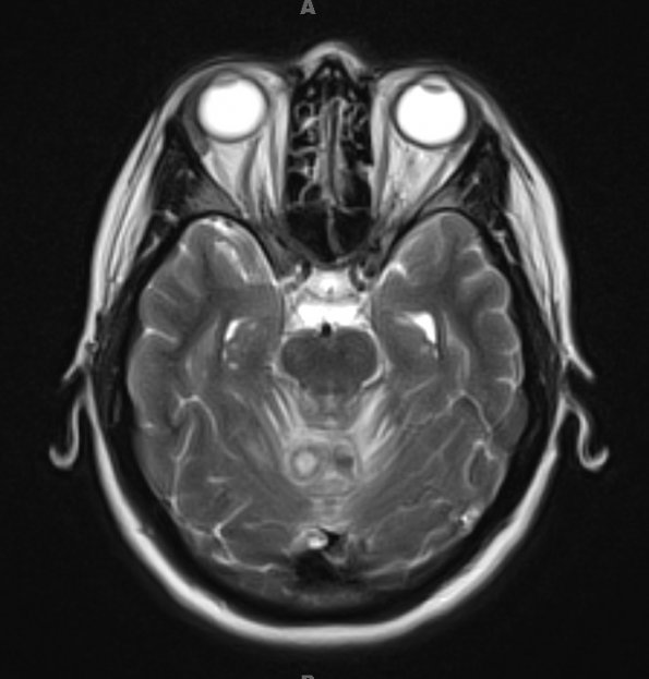 3A4 Cerebritis (Case 3) T2 - Copy