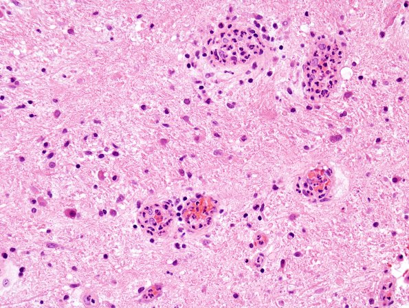 3B1 Abscess-Cerebritis (Case 3) H&E 4